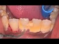 大規模な歯石の洗浄-歯石の除去 🦷 [Remove Massive Hidden Teeth Tartar] #105 DentalClinic
