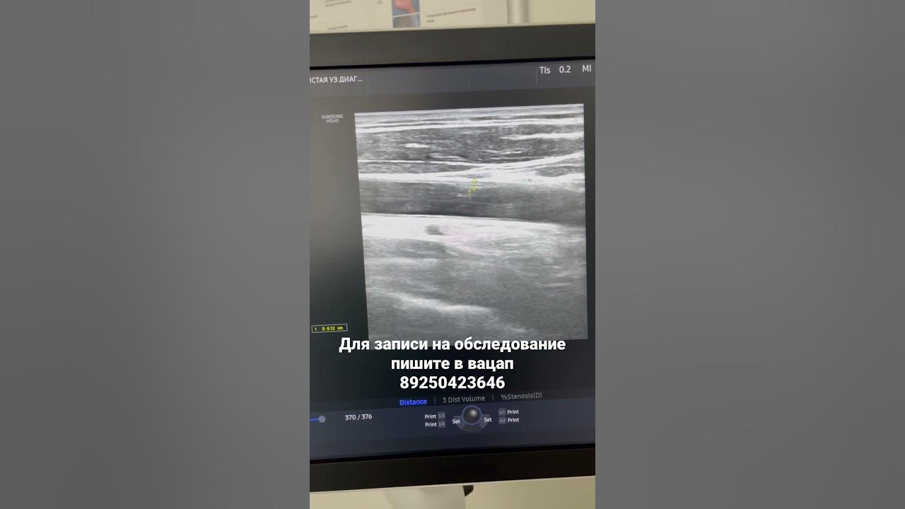Формирование бляшки. Атеросклероз. Как лечить атеросклероз? Как снизить ...