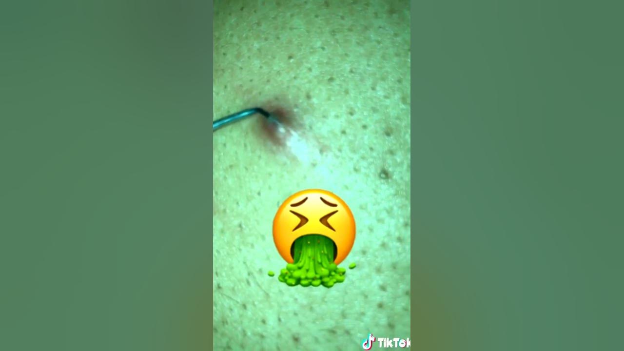 Blackheads today Blackheads loan nguyen YouTube