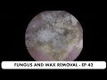 FUNGAL EAR INFECTION AND EAR WAX REMOVAL - EP 42