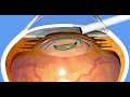 Premium Lens Implantation after Cataract Surgery (IOLs)