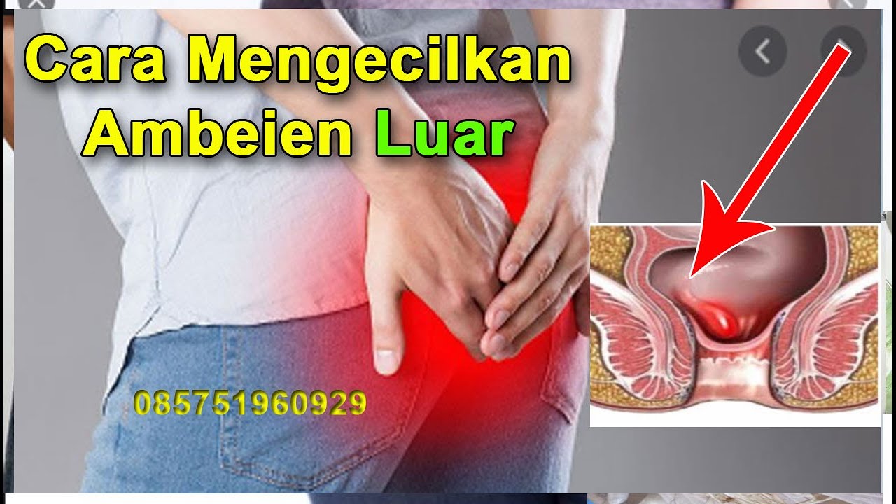 Cara Mengecilkan Ambeien Luar