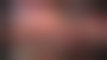 ConMed Linvatec Total Laparoscopic Hysterectomy Using Altrus® and VCare® Surgical Technique Video