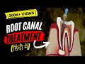Root canal treatment in Hindi