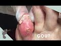 GOUT | Crystals ooze from toe