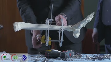 WS 10 correction of equinus Deformity