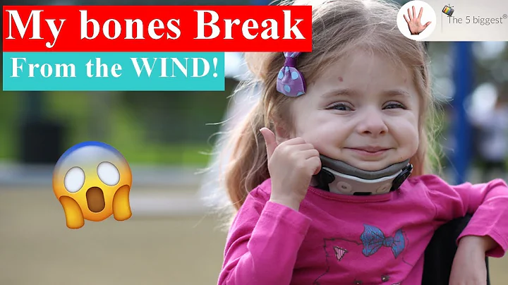 Their DNA Mutation Gives Them Bones of Glass and They Break! ~ Body Bizarre!