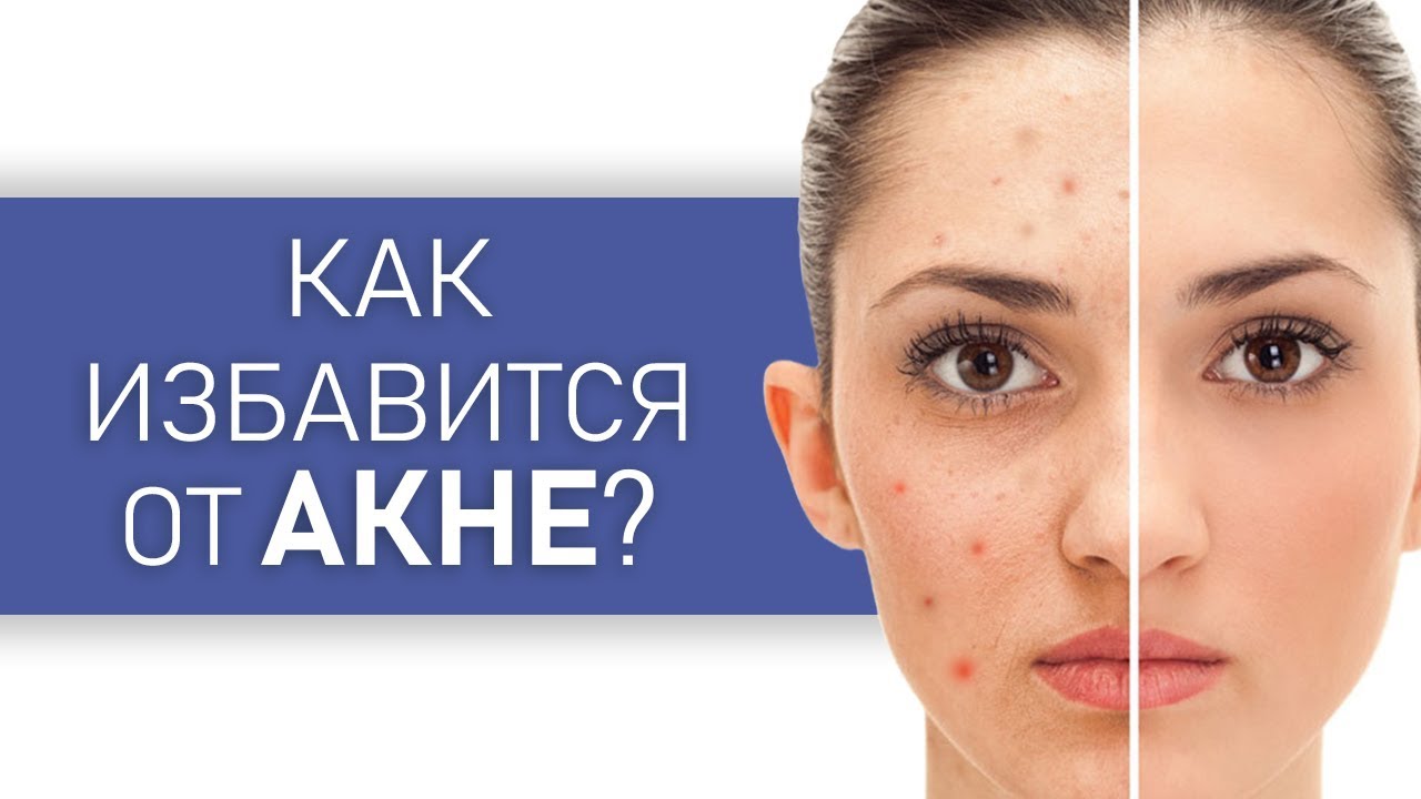 Акне. Как избавиться от ПРЫЩЕЙ, Угрей и черных точек | Как вылечить ...