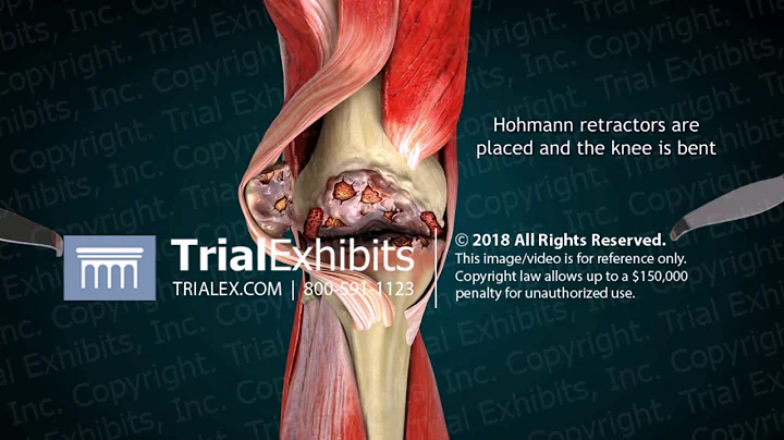 3D Animation of Right Total Knee Replacement