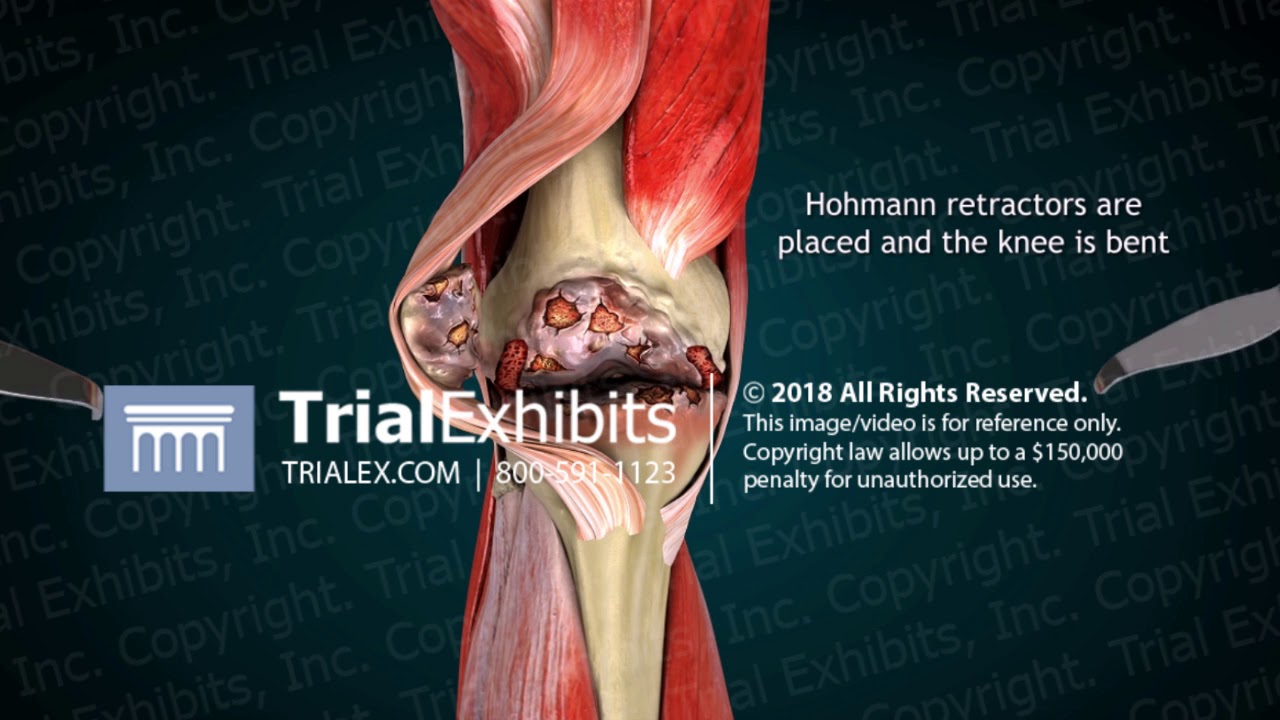 3d Animation Of Right Total Knee Replacement Youtube