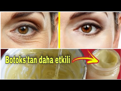 Botoks'tan Vazgeçirir! Göz Çevresi  Kırışıklarına Çözüm, Kaz Ayaklarını Yok Eden Bal Mumu Kremi