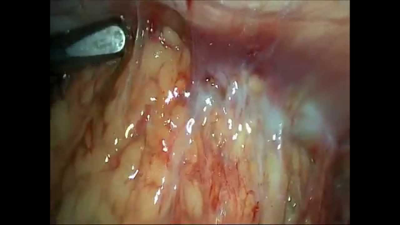 17 сутки после родов.Абсцесс параметрия,Перитонит.