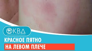 картинка: 😕 Красное пятно на левом плече. Клинический случай №816