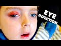 LITTLE BOY WITH KRABBE DISEASE BATTLES EYE INFECTION | Dr  Paul