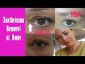 Xanthelasma removal at home   how i removed mine 3 years ago  fatty eye cholesterol deposit