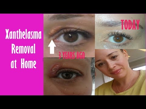 Xanthelasma Removal at Home | How I Removed Mine 3 Years Ago | Fatty Eye Cholesterol Deposit