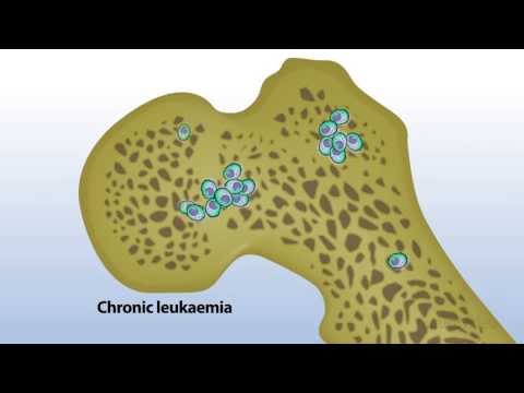 Video: Leukeemia On üksildane Haigus