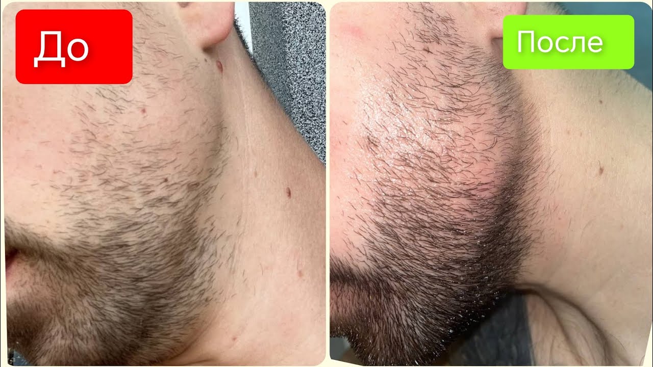 Капиксил М 5% результаты / как сделать бороду гуще / Выпуск 61 Андрей Борода