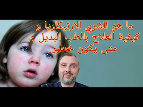 فيديو: كيف يبدو الشرى عند الأطفال؟