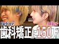 【元出っ歯】整形依存症アイドルが語る歯科矯正