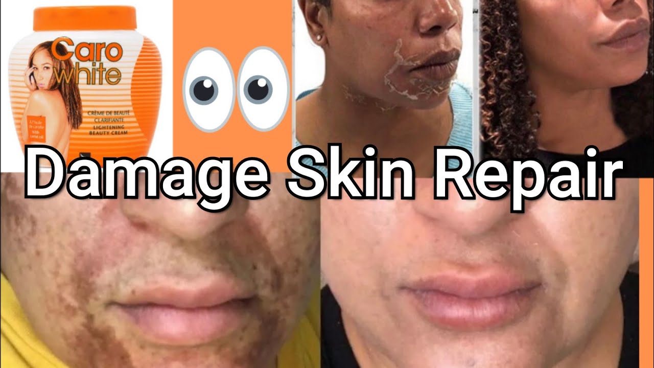 Will Caro WHITE Damage My SkinHow To bleach/whiten skin then return