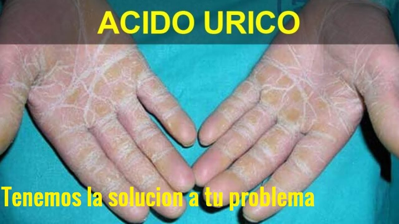 Acido úrico alto