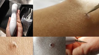 मैंने finally try किया Freckle और mole removal pen। देखिए इसे कैसे use करना है।