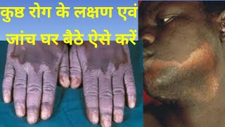 How to test for leprosy Disease and its symptoms (कुष्ठ रोग की जांच एवं लक्षण)