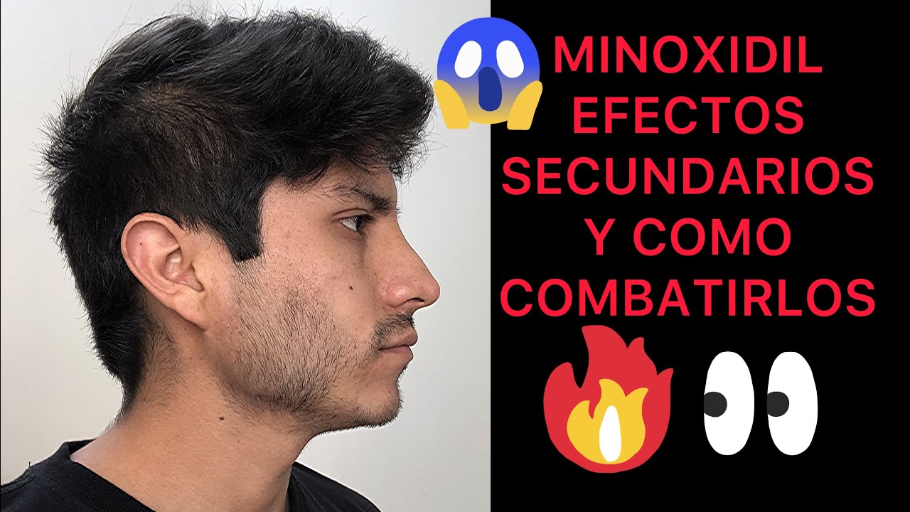 Minoxidil Efectos secundarios y cómo combatirlos YouTube Minoxidil Efectos secundarios y cómo combatirlos YouTube