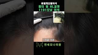 비절개모발이식 남성 앞머리 및 헤어라인 교정 1191모낭 수술 후 7개월 #엠자이마 #m자탈모 #모발이식 #비절개모발이식 #연세모나의원 #모발이식병원#모나의원#헤어라인전문센터