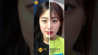 Korean Double Jaw Surgery + V-Line Surgery Surgery Results | (Before & After)