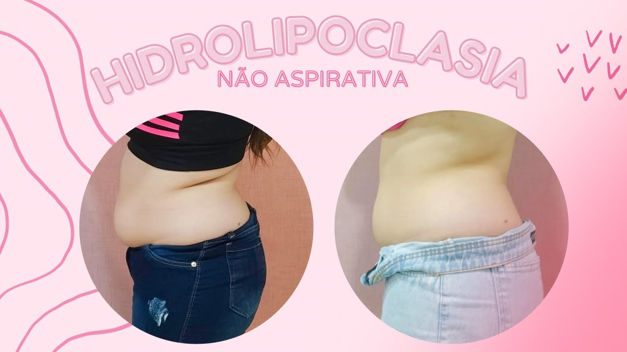 Hidrolipoclasia Antes E Depois 1 Sessão - RETOEDU