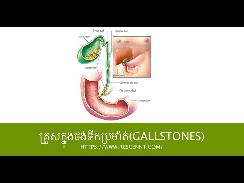 គ្រួសក្នុងថង់ទឹកប្រម៉ាត់ Gallstones
