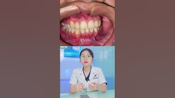 Quy trình tẩy trắng răng sau niềng diễn ra thế nào? | Lạc Việt Intech Niềng Răng #shorts