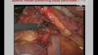 Minimally Invasive Liver and Pancreas Surgery