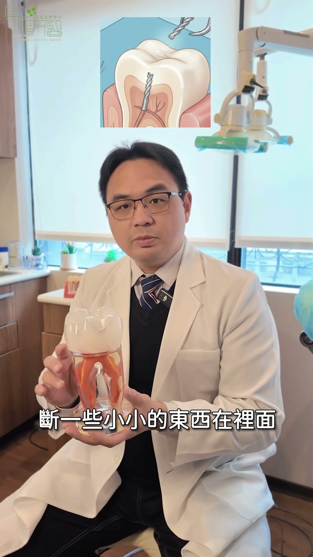 根管治療