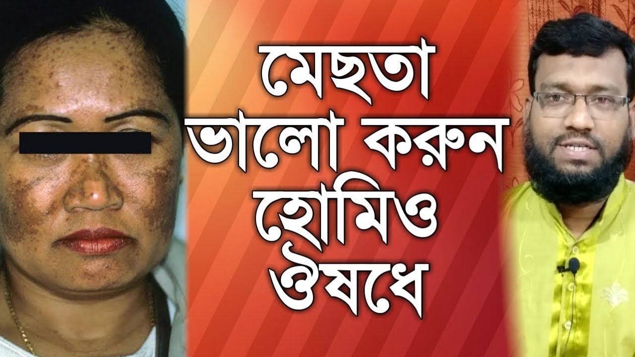 মেছতা দূর করতে সফল হোমিওপ্যাথি ঔষধ | melasma homeopathy treatment in bangla