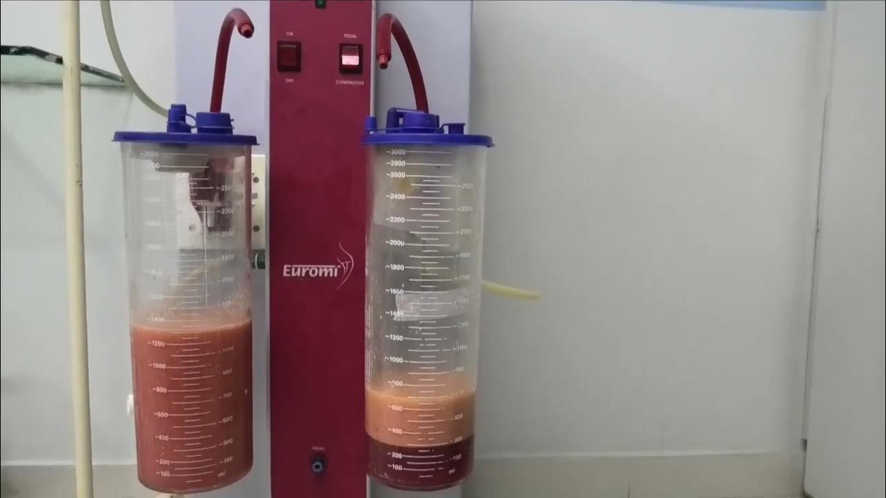 Liposuction and Surgery under Local Anesthesia. YouTube