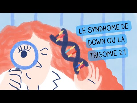 Vidéo: Syndrome De Down à L'échographie