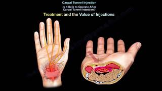 Carpal Tunnel Injection. Is injection helpful? by nabil ebraheim 5,164 views 2 months ago 5 minutes, 43 seconds