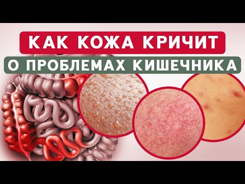 ЭТИ 4 признака говорят о проблемах с ЖКТ / Причины возникновения АКНЕ