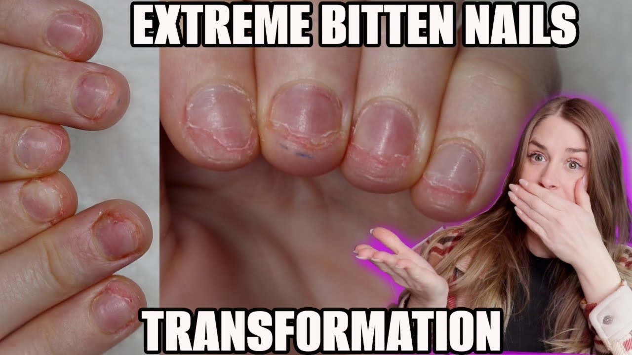 EXTREME BITTEN NAIL TRANSFORMATION | on myself doing a natural baby boomer look