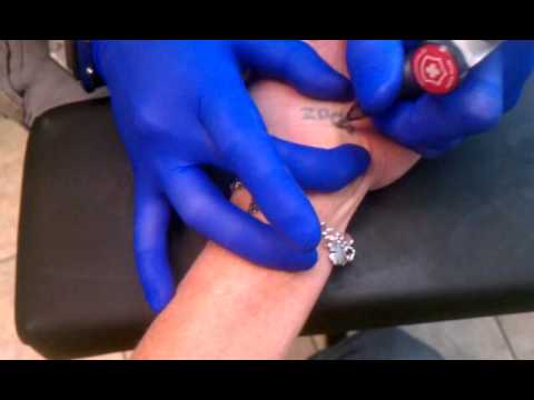 My "blowout" tattoo removal - YouTube