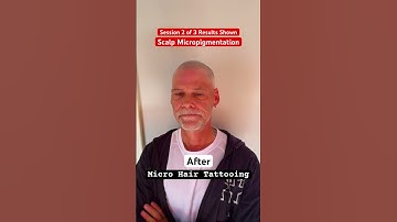 Session 2 of 3 Results Shown #smp #scalpmicropigmentation #hairlosstreatment #smptraining #edmonton