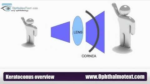 Keratoconus overview