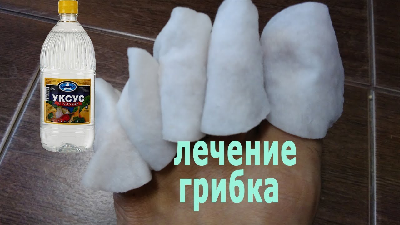Как вылечить грибок ногтей уксусом видео thumbnail