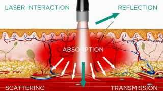 grade 4 laser therapy