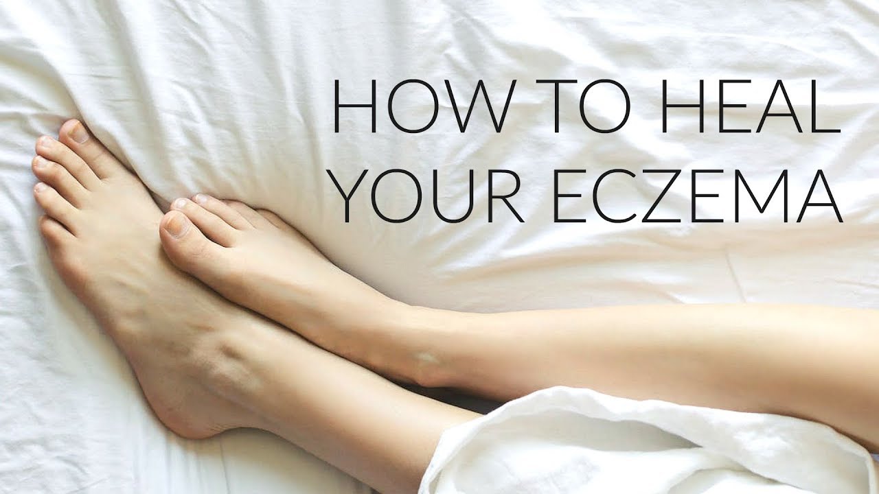 HEAL YOUR ECZEMA | Top 5 Tips to Heal Eczema 