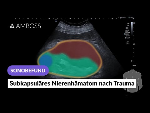 Sonobefund: Subkapsuläres Nierenhämatom nach Trauma | AMBOSS