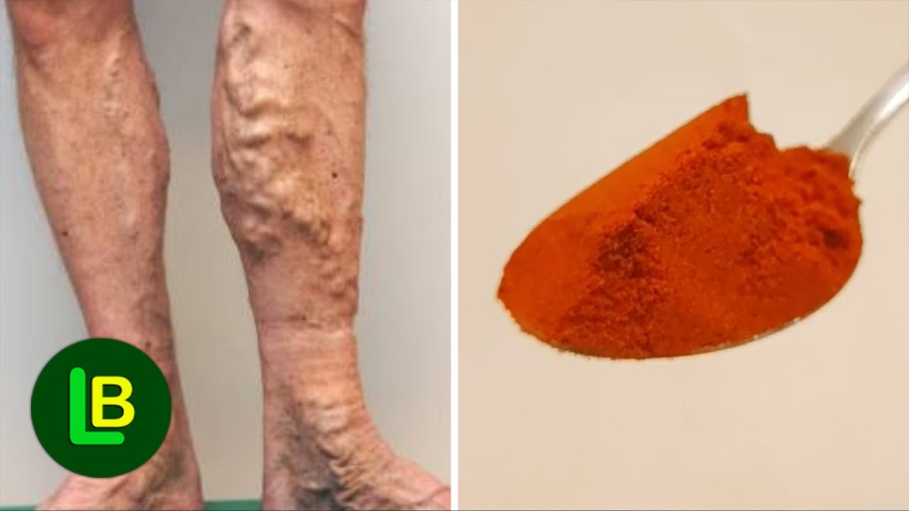 Proširene vene i slaba cirkulacija su prošlost ako koristite ovaj prirodni lek